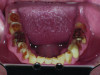 Pretreatment occlusal view of maxillary arch.