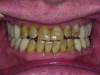 Notched deprogrammer at midpoint on platform from awake bruxism (clenching).