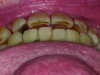 Frontal view of posterior zirconia crowns post-treatment.
