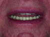 Post-orthodontic treatment showing overbite and improved midline.