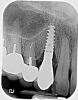 Fig 1. Pretreatment radiograph of the implant, maxillary right canine site. Bone loss was suggested at the mesial and distal aspects. v