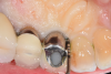 Fig 2. Presurgical palatal view of the implant demonstrating 8 mm probing depth.