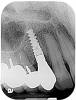 Fig 9. Radiograph exposed at 1 year following the surgery suggested favorable bone gains achieved by eradicating the infraosseous lesions.