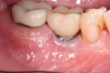 Fig 15. Healing at 10 months postoperative. Although now thinner than preoperatively, the gingival tissue appeared healthier.