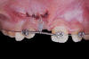 Fig 17. Flap was then repositioned closed after the orthodontic attachment was bonded to start the traction of the impacted maxillary right central incisor.