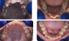 Fig 3. Pretreatment (top panels) and peri-treatment (bottom panels) intraoral photographs.