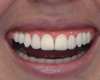 Fig 13. Monotonic smile: Incisal edges of both the lateral and central incisors align with the smile curve.