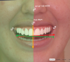 Fig 15. Deviations in facial flow. Based on the facial flow analysis, in order to achieve facial harmony the smile design (inclination of the smile design plane) should follow the green area of the face. When the inclination of the smile design plane follows the red area of the face, a visual tension is created in the face by crossing lines: the smile design plane and the orientation of the facial flow.