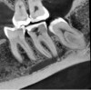 Figure 1. High-resolution, focused field-of-view CBCT scan of the posterior left mandible.
