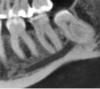 Figure 2. Low-dose, large field-of-view CBCT scan on the same patient.