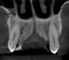 Figure 3. Coronal view of the anterior maxilla presenting the “s-shaped” canalis sinuosus on the right side.