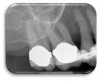 Figure 4. Periapical radiograph of the posterior right maxilla .