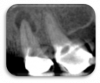 Figure 5. Sagittal view of a focused field-of-view CBCT scan on the same patient shown in Figure 4.