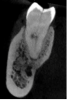 Figure 6. Coronal view showing a radicular fracture extending from the occlusal surface.