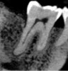 Figure 7. Sagittal view of the same tooth shown in Figure 6 presenting localized angular bone loss on the distal aspect.