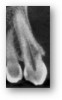 Figures 8. External cervical resorption on thin CBCT slices varying in extent, location, and occupying volume.