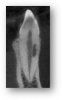 Figures 9. External cervical resorption on thin CBCT slices varying in extent, location, and occupying volume.