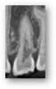 Figures 10. External cervical resorption on thin CBCT slices varying in extent, location, and occupying volume.