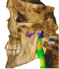 Figure 11. Airway analysis presented on the volume rendering of a large field-of-view CBCT scan.