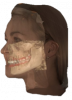 Figure 12. Volume rendering merged with facial scan and digital impression for patient education.