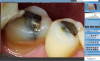 Fig 2. When viewed on a screen in the examining room, digital intraoral photographs can be easily understood by patients.