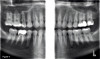 Fig 4. Full-mouth series and periapical radiographs. During both initial and recare examinations, 2D periapical (PA) digital radiographs can be taken using either sensors or phosphor plates for a full range of diagnostic imaging, both providing excellent resolution and lower radiation exposure.
