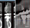 Fig 7. A 2D view compared with a CBCT 3D view of this painful and mobile
molar implant reveals the cortical perforation improper implant placement.