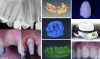 Fig 12. In this patient, endodontic therapy, a direct post and core, and a laser soft tissue crown-lengthening procedure were performed in a single day (left panels). Intraoral quadrant scans of the preparation and the occlusal and opposing teeth were taken to provide virtual models (middle panels). The crown was designed chairside, milled, crystallized, stained, glazed, and seated (right panels).
