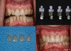Fig 13. For this patient with malposed anterior teeth, teeth Nos. 7 to 10 were prepared, veneers were designed and milled, and the restorations were stained, characterized, glazed, and seated. The entire case required 2 hours of chairtime and 2 hours of laboratory time by an assistant.