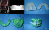 Fig 17. Fabrication of a duplicate denture. A CBCT scan of the existing denture is taken, and the image is exported as an STL file for printing. The print is essentially a duplicate of the denture, and it is used as a custom impression tray and a tray for bite registration
