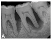 (7.) Progressive improvement in bone quality, quantity, and morphology during each time period, especially in the furcation area of tooth No. 18, which shows a noticeable narrowing of the width of the bony defects, slight apical resorption of the distal root of tooth No. 18, and the encasing of residual cementum on the distal root of No. 19 by new bone formation. Periapical radiographs were taken of teeth Nos. 17, 18, and 19 on June 25, 2016, January 28, 2017, August 23, 2019, and September 4, 2020, respectively, the final of which was taken after almost 5 years post-initial scaling and root planing and alternating supportive periodontal maintenance.