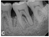 (9.) Progressive improvement in bone quality, quantity, and morphology during each time period, especially in the furcation area of tooth No. 18, which shows a noticeable narrowing of the width of the bony defects, slight apical resorption of the distal root of tooth No. 18, and the encasing of residual cementum on the distal root of No. 19 by new bone formation. Periapical radiographs were taken of teeth Nos. 17, 18, and 19 on June 25, 2016, January 28, 2017, August 23, 2019, and September 4, 2020, respectively, the final of which was taken after almost 5 years post-initial scaling and root planing and alternating supportive periodontal maintenance.