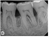 (10.) Progressive improvement in bone quality, quantity, and morphology during each time period, especially in the furcation area of tooth No. 18, which shows a noticeable narrowing of the width of the bony defects, slight apical resorption of the distal root of tooth No. 18, and the encasing of residual cementum on the distal root of No. 19 by new bone formation. Periapical radiographs were taken of teeth Nos. 17, 18, and 19 on June 25, 2016, January 28, 2017, August 23, 2019, and September 4, 2020, respectively, the final of which was taken after almost 5 years post-initial scaling and root planing and alternating supportive periodontal maintenance.
