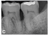 (13.) Follow-up radiographs taken of teeth Nos. 17, 18, and 19 on September 4, 2020 after almost 5 years post-initial scaling and root planing and alternating supportive periodontal maintenance therapy only.