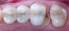 Fig 10. This patient presented with a fractured all-ceramic restoration on tooth No. 14. The clinician chose to provide treatment using all-digital technology, from the initial impression scan to the milling of the new restoration.
