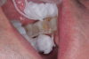(3.) Patient presented with sensitivity for 6 months on tooth No. 18.