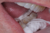 (4.) Patient presented with sensitivity for 6 months on tooth No. 18.