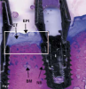 Fig 2. The implant depicted is surrounded by bone indicating a high BIC (histological slide courtesy of Dennis P. Tarnow, DDS). The white box denotes the interface between the soft and hard tissues. Legend: EPI = epithelium, CT = connective tissue, I = implant, BM = bone marrow, NB = native bone.