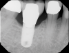 Fig 5. Periapical radiograph of implant No. 30, which helped in the evaluation of the extent of the cupping defect seen around the implant site.