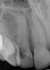 (6.) Close-up clinical and radiographic views of an ECR lesion presenting as a pink spot on the cervical aspect of tooth No. 7.