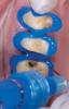 (3.) Prior to placing the restorations, the enamel of the abutment teeth is selectively etched with phosphoric acid for 20 seconds and a self-etch dentin primer is applied.