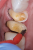 (4.) Prior to placing the restorations, the enamel of the abutment teeth is selectively etched with phosphoric acid for 20 seconds and a self-etch dentin primer is applied.