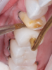 (5.) Step C: the restorations are inserted with a dual-cure composite resin, and the excess composite material is cleaned with a sable brush.