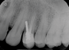 Fig 2. Improper metal post placement/perforation (dentistry courtesy of Riccardo Tonini, MD, DDS).