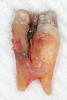 Fig 5. Root fracture occurred in this maxillary premolar as a result of corrosion of a non-noble metal alloy post.