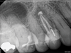 Fig 5. Case demonstrating successful healing of tooth No. 5 following a flare-up incident. Fig 2: Patient presented with asymptomatic apical periodontitis of tooth No. 5. Fig 3: Following initiation of NSRCT, the patient developed a flare-up with swelling and pain. Amoxicillin was prescribed and the calcium hydroxide medicament was replaced. Fig 4: The patient returned 3 months later with radiographic healing of the apical periodontium. Fig 5: Obturation was completed.