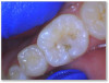 Fig 4a. Carious lesion on tooth No. 19 requiring
a deep excavation in which an indirect pulp cap was performed using a light curable resin-modified calcium silicate (Bisco TheraCal LC), and
the tooth was subsequently restored in two separate steps using Kerr SimpliShade Bulk Fill Flow followed by SimpliShade Bulk Fill Packable
as the capping layer.