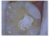 Fig 4c. Carious lesion on tooth No. 19 requiring
a deep excavation in which an indirect pulp cap was performed using a light curable resin-modified calcium silicate (Bisco TheraCal LC), and
the tooth was subsequently restored in two separate steps using Kerr SimpliShade Bulk Fill Flow followed by SimpliShade Bulk Fill Packable
as the capping layer.