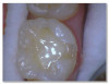 Fig 4d. Carious lesion on tooth No. 19 requiring
a deep excavation in which an indirect pulp cap was performed using a light curable resin-modified calcium silicate (Bisco TheraCal LC), and
the tooth was subsequently restored in two separate steps using Kerr SimpliShade Bulk Fill Flow followed by SimpliShade Bulk Fill Packable
as the capping layer.