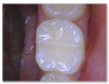 Fig 4e. Carious lesion on tooth No. 19 requiring
a deep excavation in which an indirect pulp cap was performed using a light curable resin-modified calcium silicate (Bisco TheraCal LC), and
the tooth was subsequently restored in two separate steps using Kerr SimpliShade Bulk Fill Flow followed by SimpliShade Bulk Fill Packable
as the capping layer.